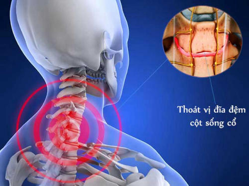 Ngủ dậy bị đau cổ: Nguyên nhân và cách ngăn ngừa